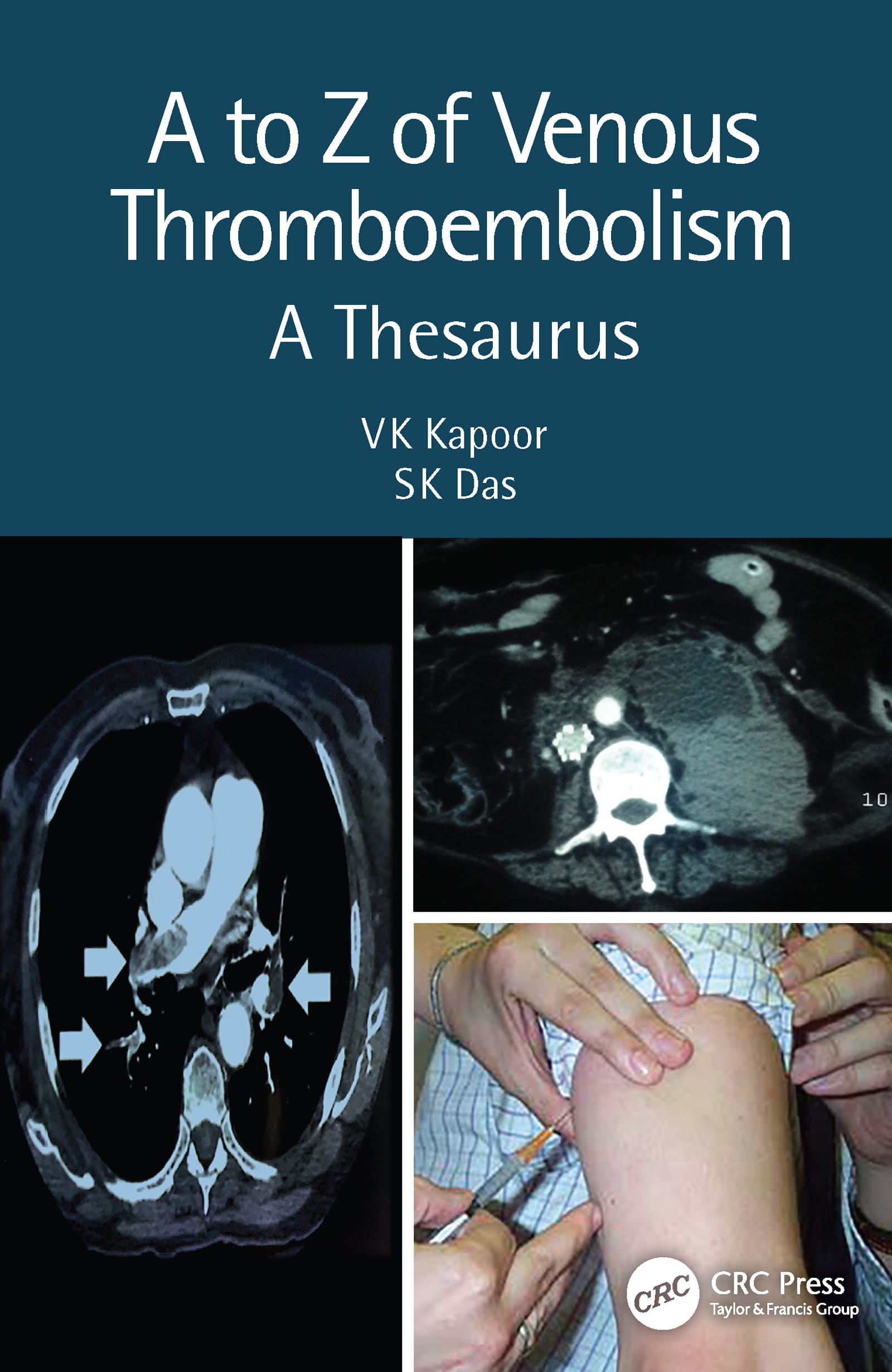 A to Z of Venous Thrombo-Embolism: A Thesaurus, 2nd Edition