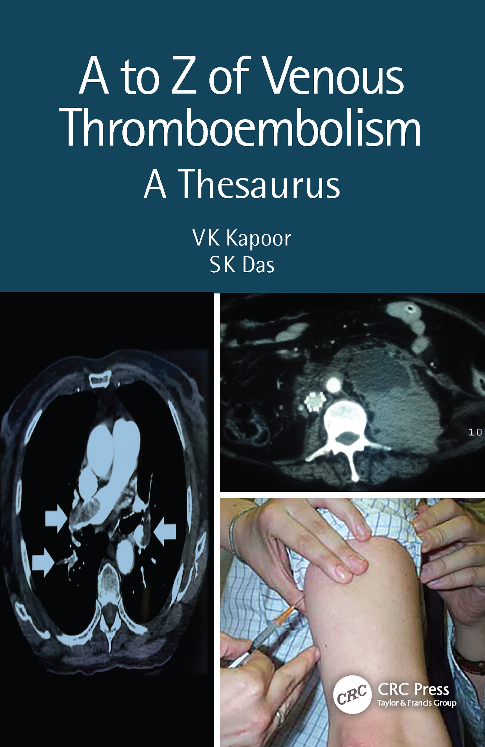 A to Z of Venous Thrombo-Embolism: A Thesaurus, 2nd Edition